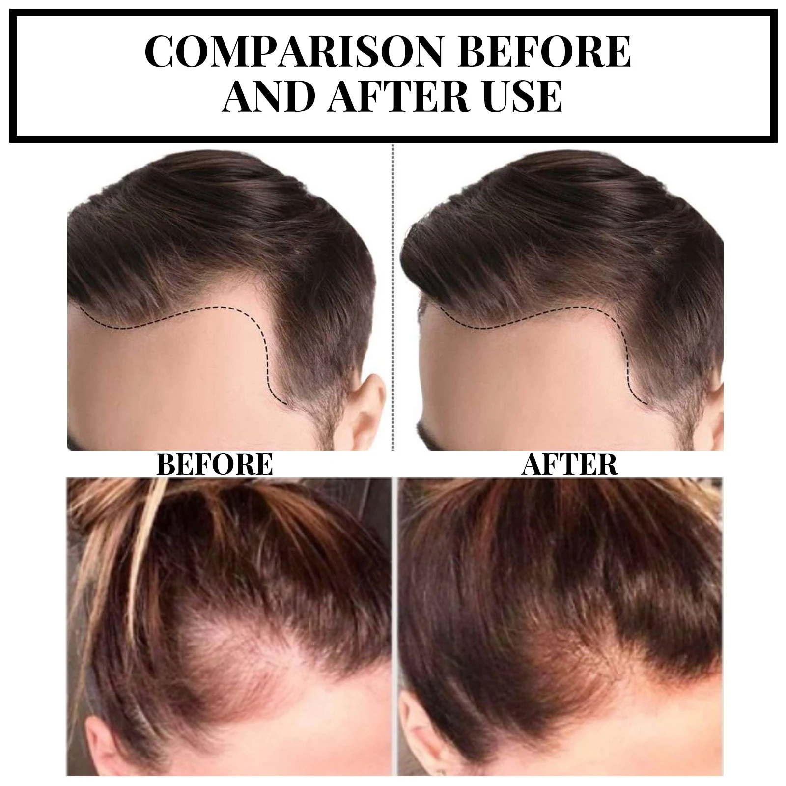 EELHOE Ginger Root Oil For Hair — hairline comparison artwork.