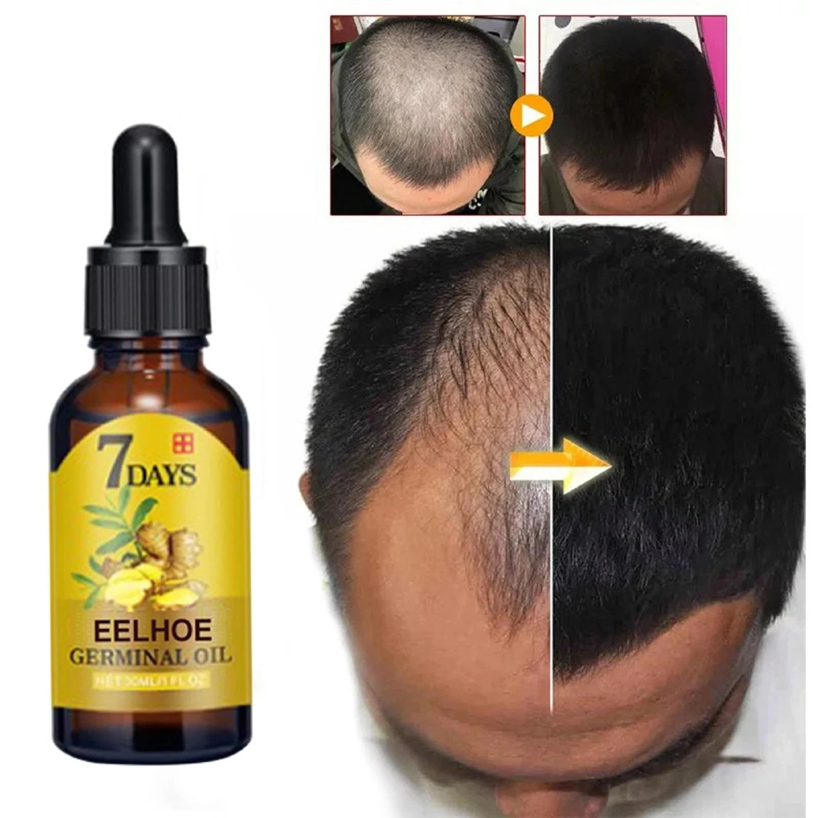 EELHOE Scalp appearance comparison artwork