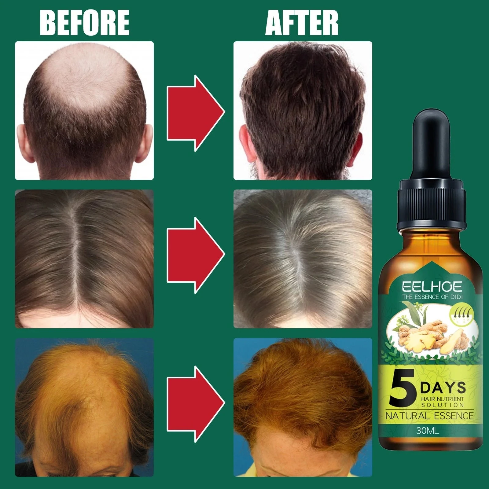 EELHOE Ginger Hair Growth Oil — Product hairline and crown comparison photographs.