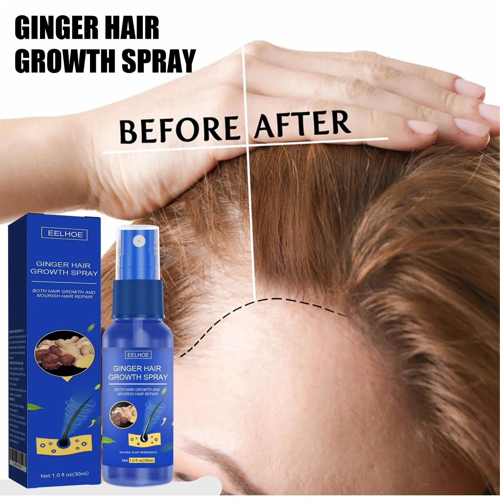 EELHOE Hair Growth Spray For Thinning Hair — Hairline comparison photograph with the spray bottle.
